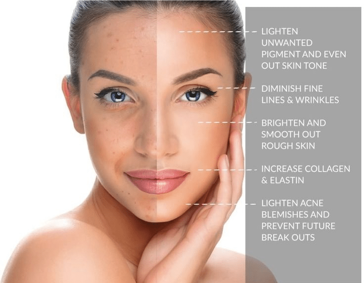 What is the Difference Between a Light, Medium, and Deep Chemical Peel?